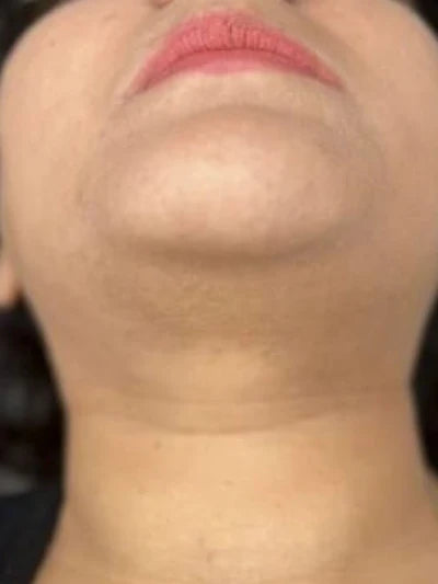 [REPLACE: IMG-6 Week 8 - under-jaw smooth, identical framing]
