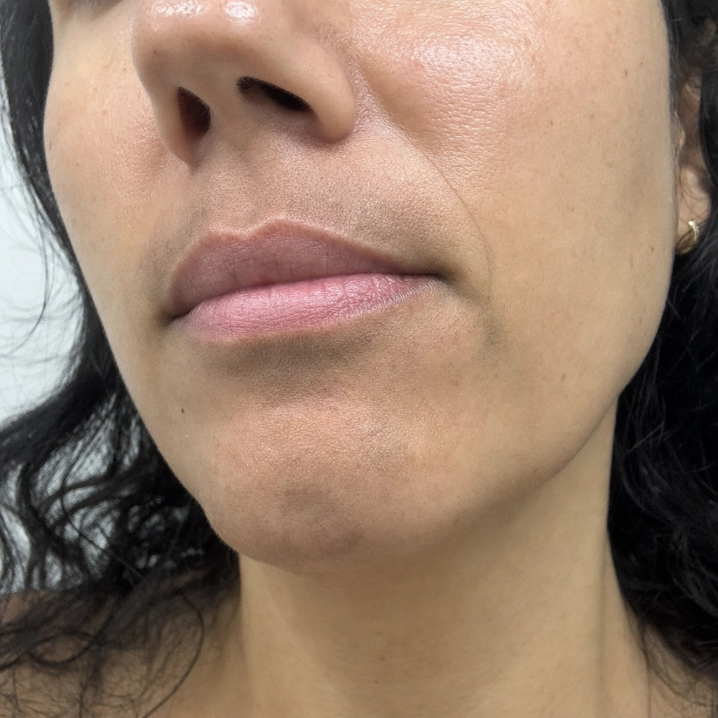 Post-inflammatory pigmentation close-up